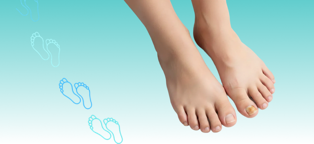 Mit diesen Tipps wirst du Nagelpilz los!