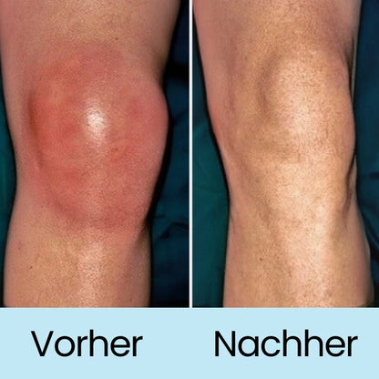 KneeRelief™️ natürliches Knie‑Schmerzpflaster