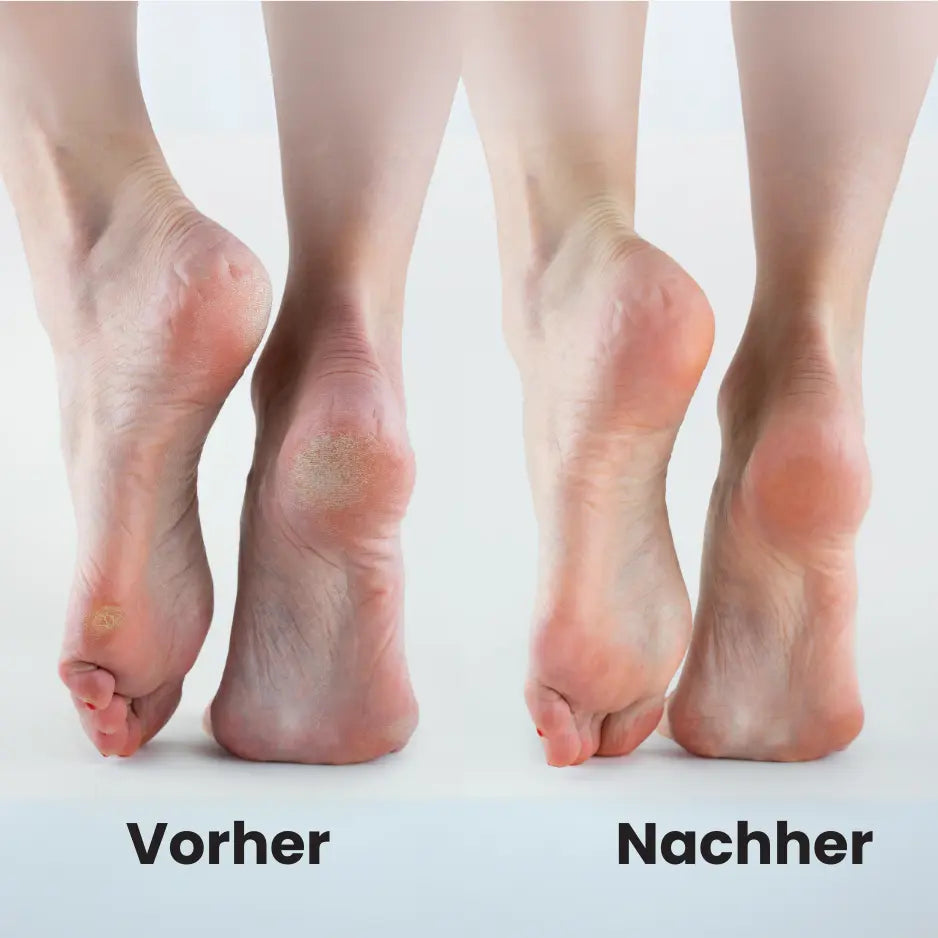 Elektrischer Hornhaut Entferner - PediPro™