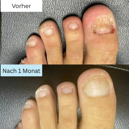 RevitaNail Nagelpilz Therapie