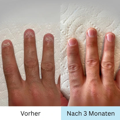 RevitaNail Nagelpilz Therapie