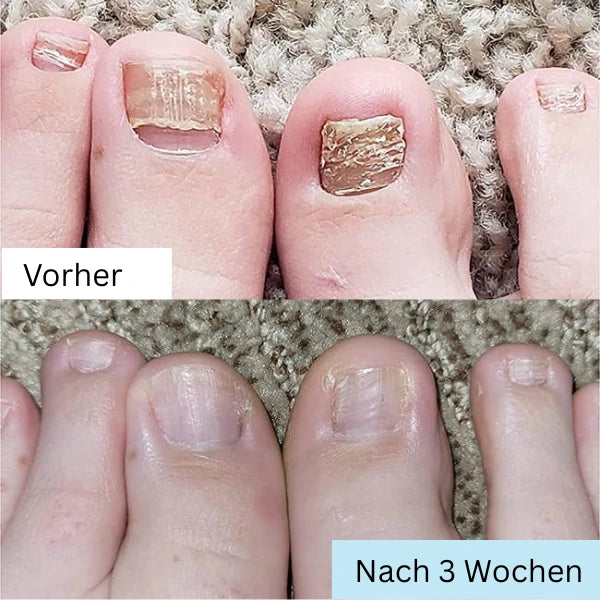 RevitaNail Nagelpilz Therapie
