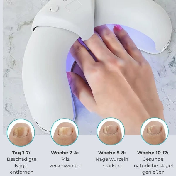 Nagelpilz Lasertherapie VitaNail