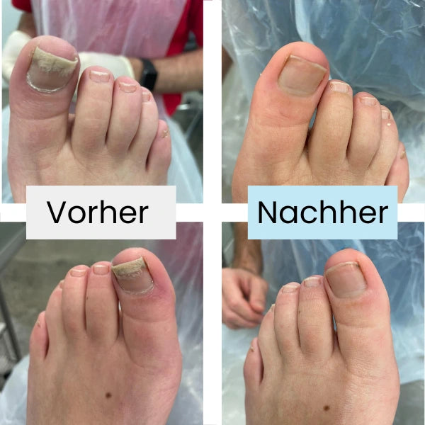 Nagelpilz Lasertherapie VitaNail
