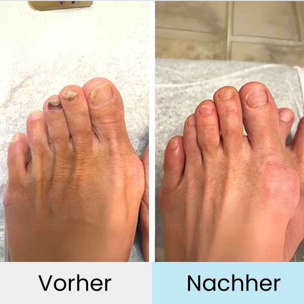 Nagelpilz Lasertherapie VitaNail