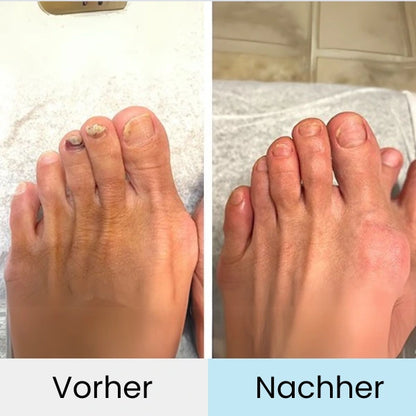 Nagelpilz Lasertherapie VitaNail